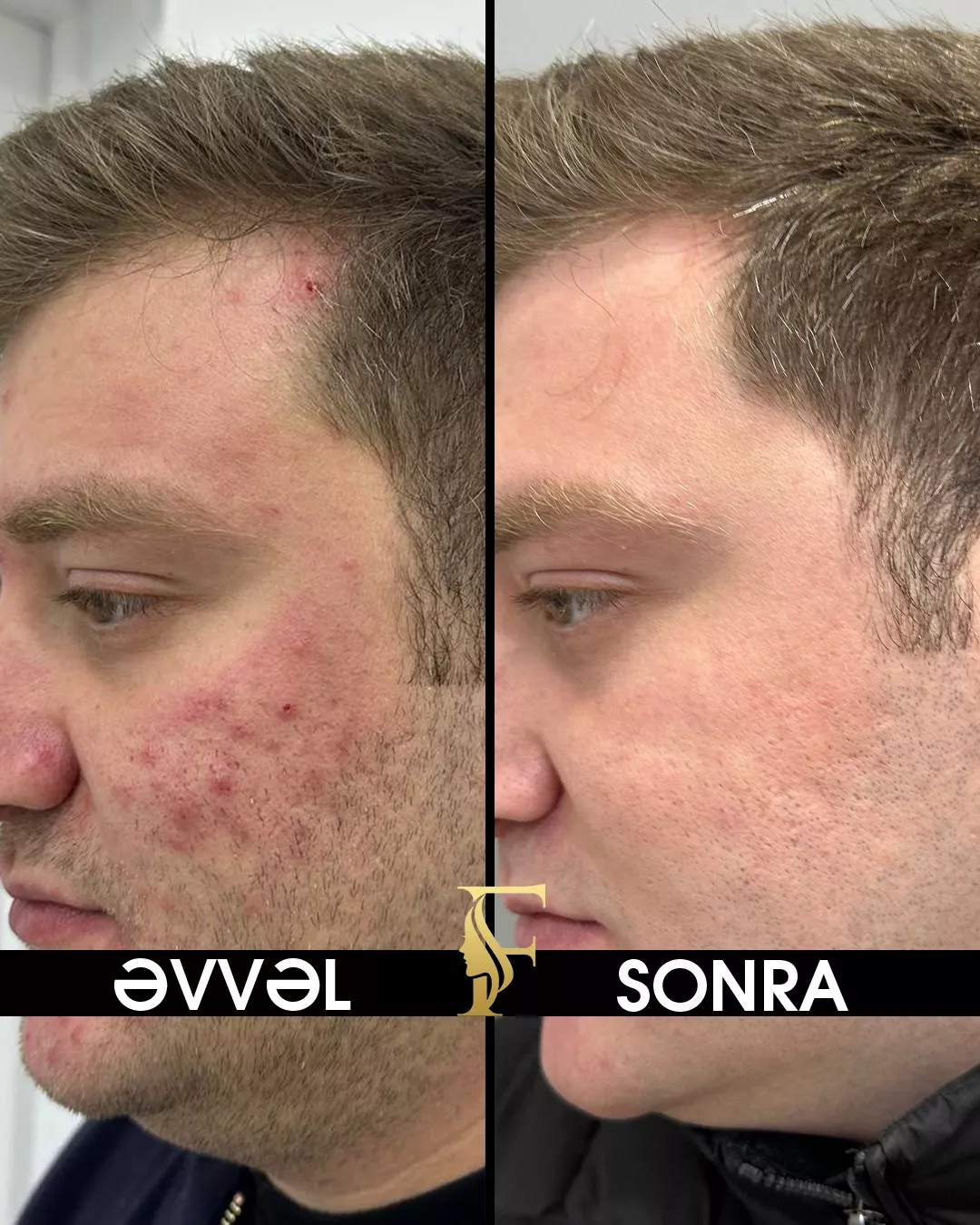 Sızanaq Müalicəsi